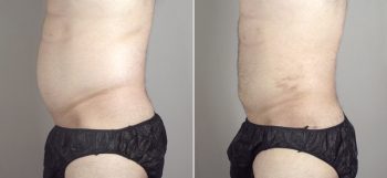 Male Liposuction Patient 16