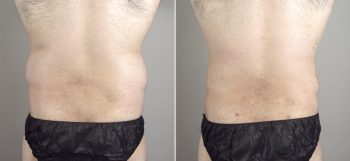 Male Liposuction Patient 16