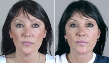 Neck Liposuction Patient 5