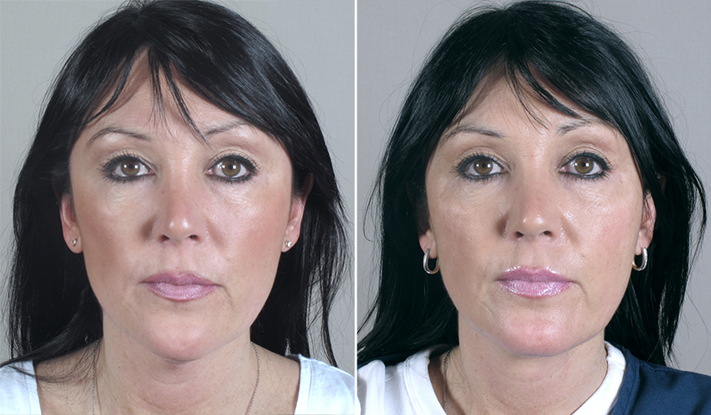 Neck Liposuction Patient 5