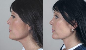 Neck Liposuction Patient 5