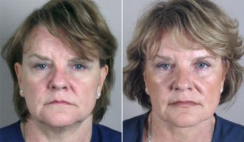 Neck Liposuction Patient 6