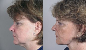 Neck Liposuction Patient 6