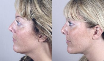 Neck Liposuction Patient 7
