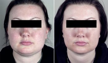 Neck Liposuction Patient 8