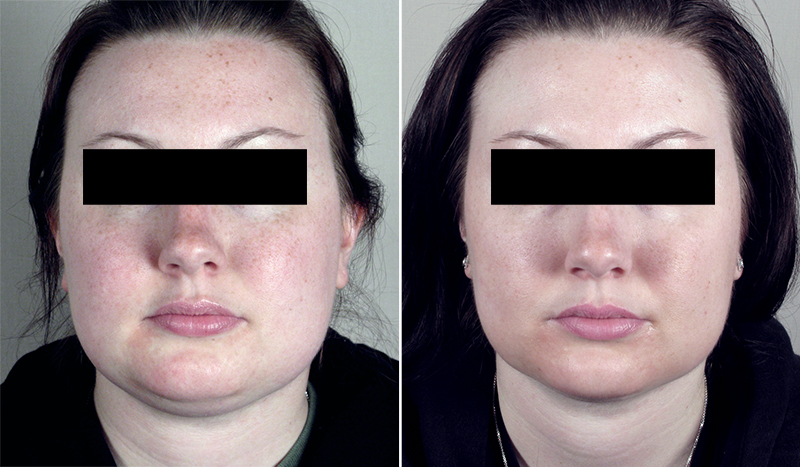 Neck Liposuction Patient 8