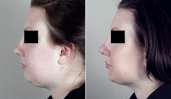 Neck Liposuction Patient 8