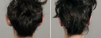 Otoplasty Patient 32