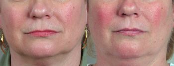 Wrinkle Reduction Patient 5 – Dermabrasion
