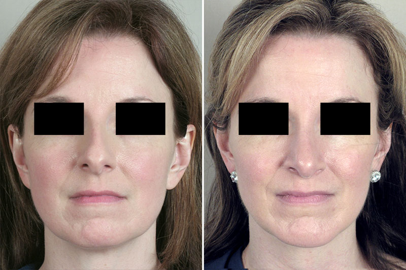 Rhinoplasty & Chin Implant Patient 28