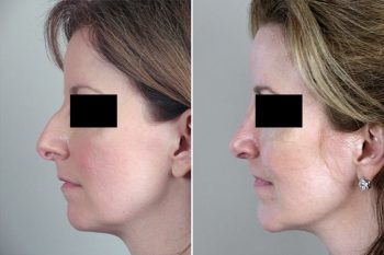 Rhinoplasty & Chin Implant Patient 28