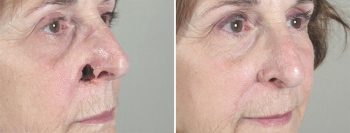 Skin Cancer Treatment Patient 25