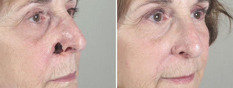 Skin Cancer Treatment Patient 25