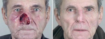 Skin Cancer Treatment Patient 26