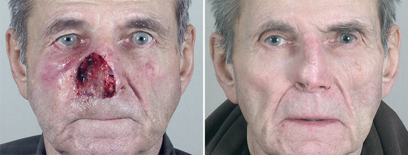 Skin Cancer Treatment Patient 26