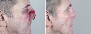 Skin Cancer Treatment Patient 26