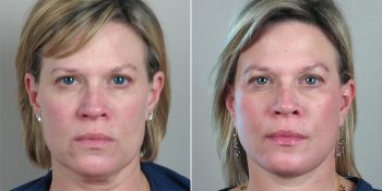 Face Lift Patient 17