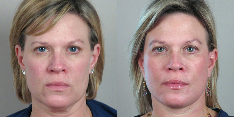 Face Lift Patient 17
