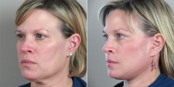 Face Lift Patient 17