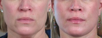 Face Lift Patient 17