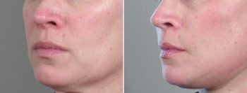 Face Lift Patient 17