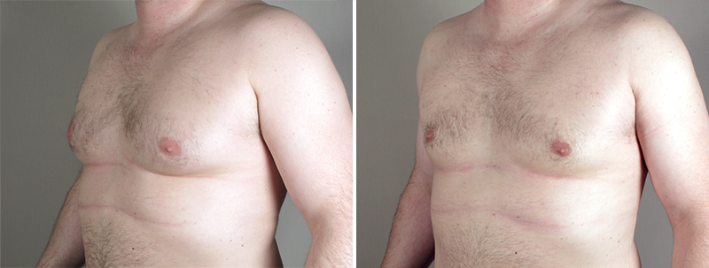 Gynecomastia Reduction Patient 22