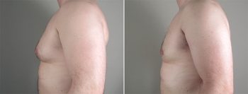 Gynecomastia Reduction Patient 22