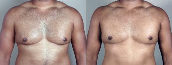 Gynecomastia Reduction Patient 23