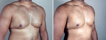 Gynecomastia Reduction Patient 23