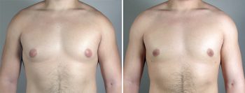 Gynecomastia Reduction Patient 24