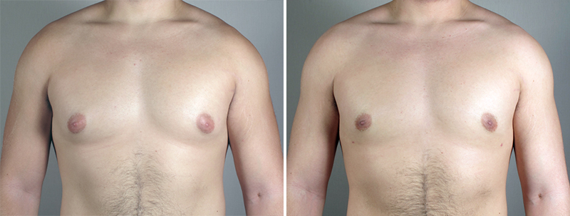 Gynecomastia Reduction Patient 24