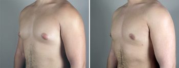 Gynecomastia Reduction Patient 24