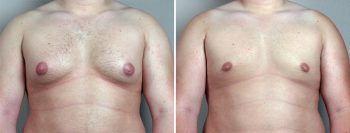 Gynecomastia Reduction Patient 25