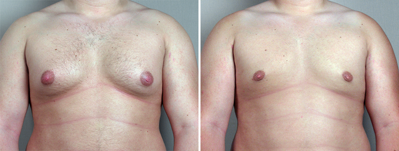Gynecomastia Reduction Patient 25