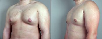 Gynecomastia Reduction Patient 25