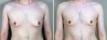 Gynecomastia Reduction Patient 26