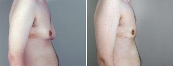 Gynecomastia Reduction Patient 26
