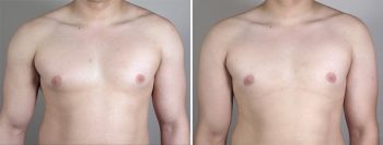 Gynecomastia Reduction Patient 27