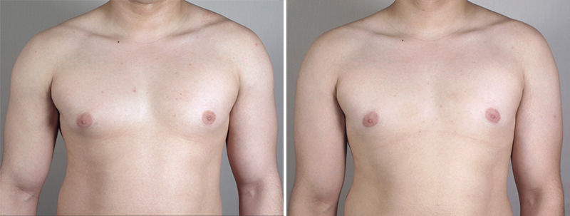 Gynecomastia Reduction Patient 27