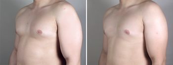 Gynecomastia Reduction Patient 27
