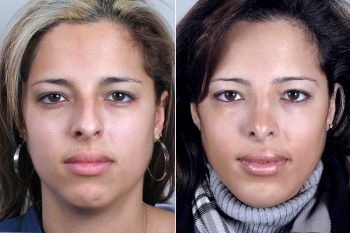 Rhinoplasty & Chin Implant Patient 29