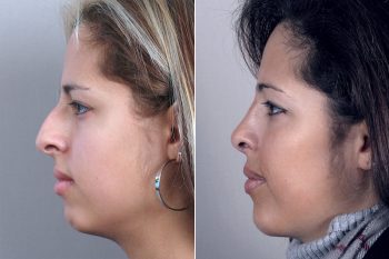 Rhinoplasty & Chin Implant Patient 29