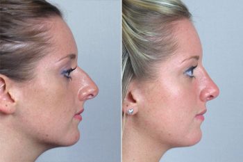 Rhinoplasty Patient 30