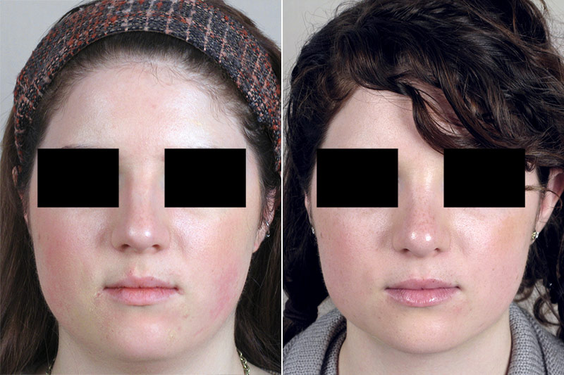 Neck Liposuction Patient 9