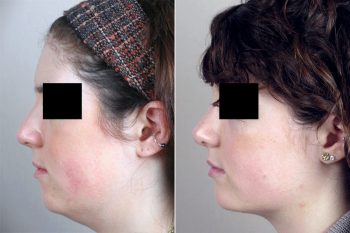 Neck Liposuction Patient 9