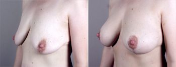 Breast Lift with Implants Patient 9