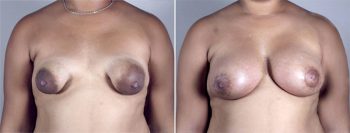 Breast Lift with Implants Patient 18 (Correction of Tuberous Breasts)