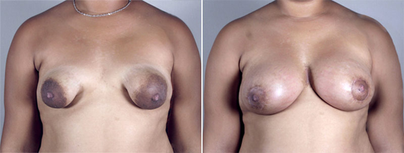 Breast Lift with Implants Patient 18 (Correction of Tuberous Breasts)