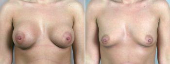 Breast Implant Removal Patient 6