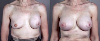 Removal & Replacement of Implants Patient 4